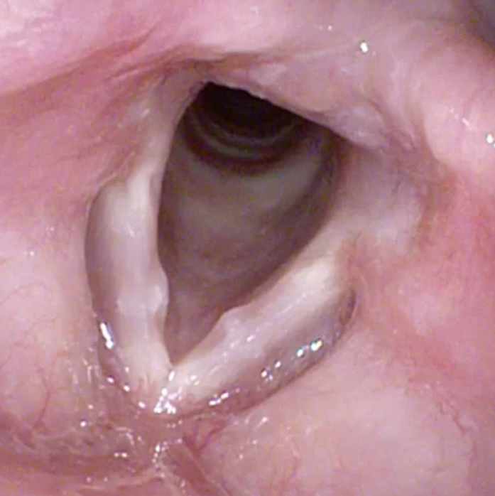 CHIRURGIA DELLA LARINGE