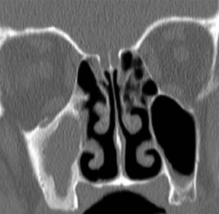 CHIRURGIA DEI SENI PARANASALI